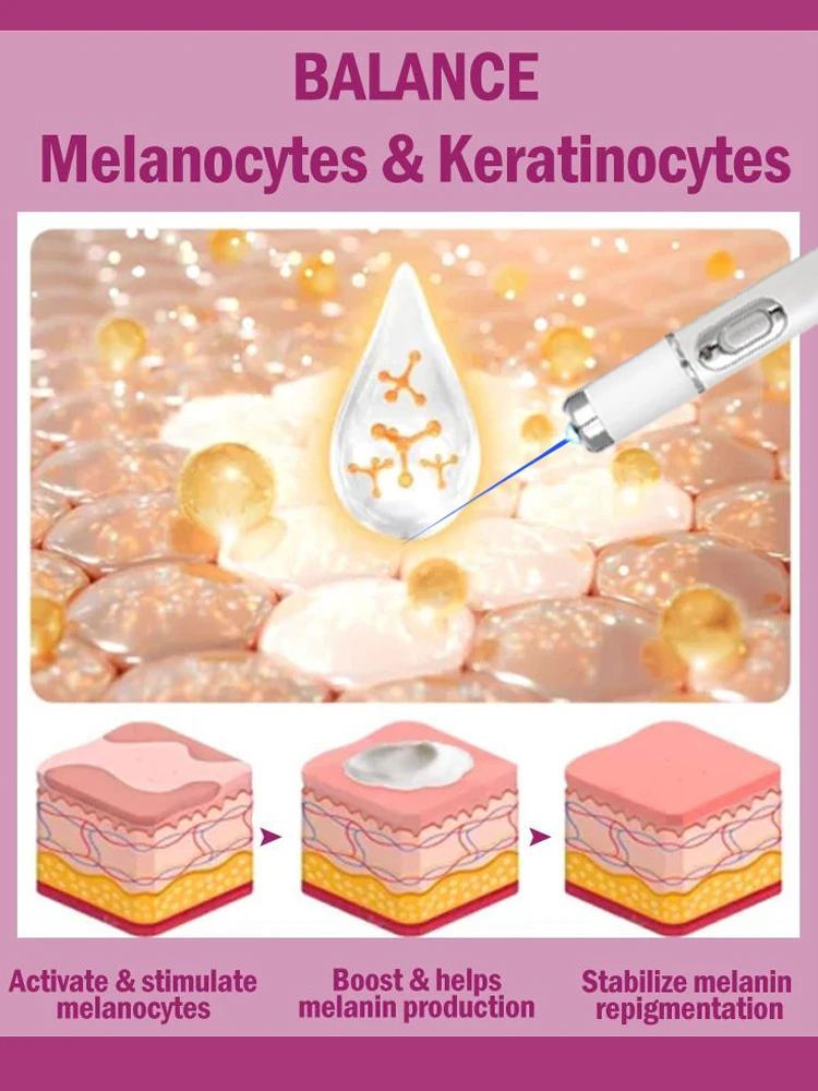 Efficient laser technology to quickly improve vitiligo - Image 5