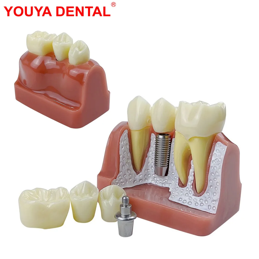 

4 Times Dental Implant Teeth Teaching Model Dentistry Removable Analysis Crown Bridge Study Model For Education Demonstration