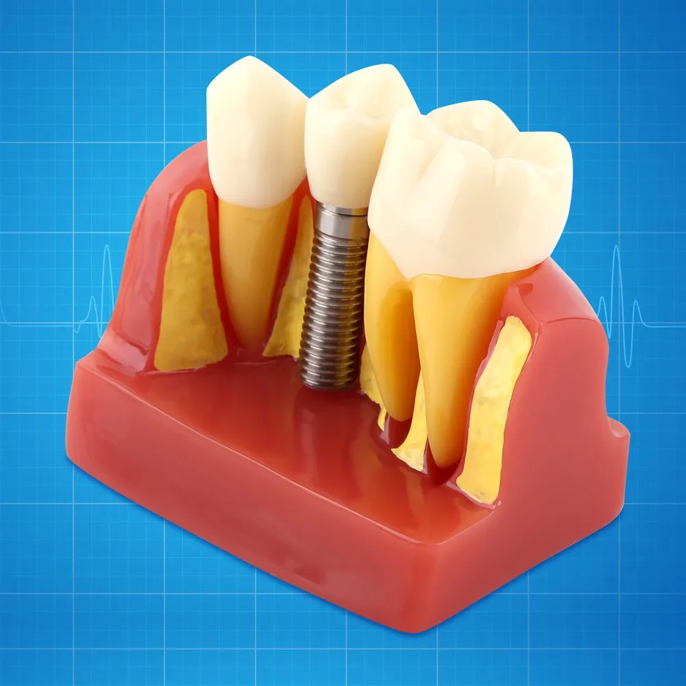 1Pcs Resin Dental Student Demonstration Tooth Model Implant Analysis Crown Bridge For Dentist Oral Medical Product Equipment