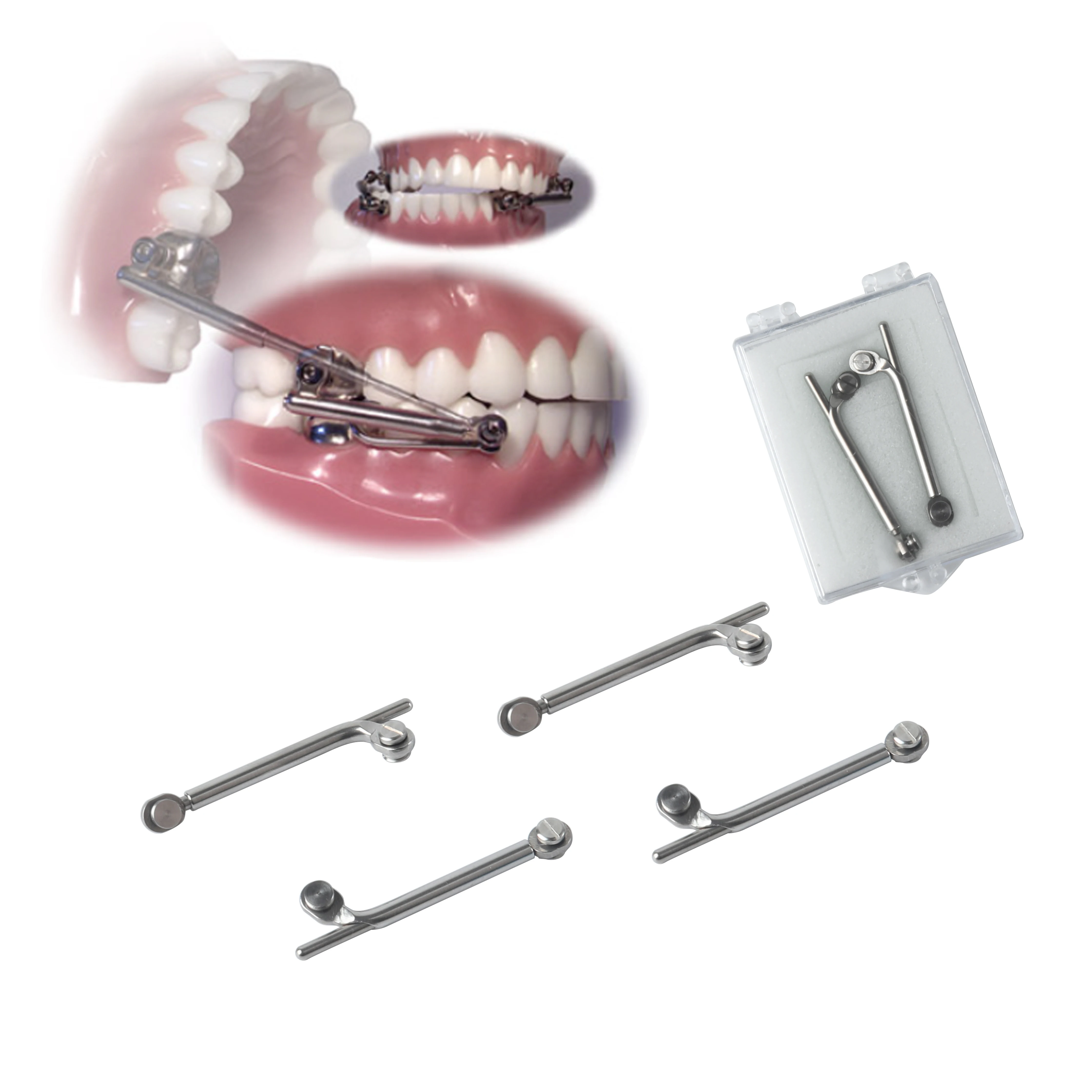 Buccal Mounted Herbst Appliance Fixed Non-Removable with Occlusal Bite Jump for Class II Correction Precision Orthodontic Device view 3