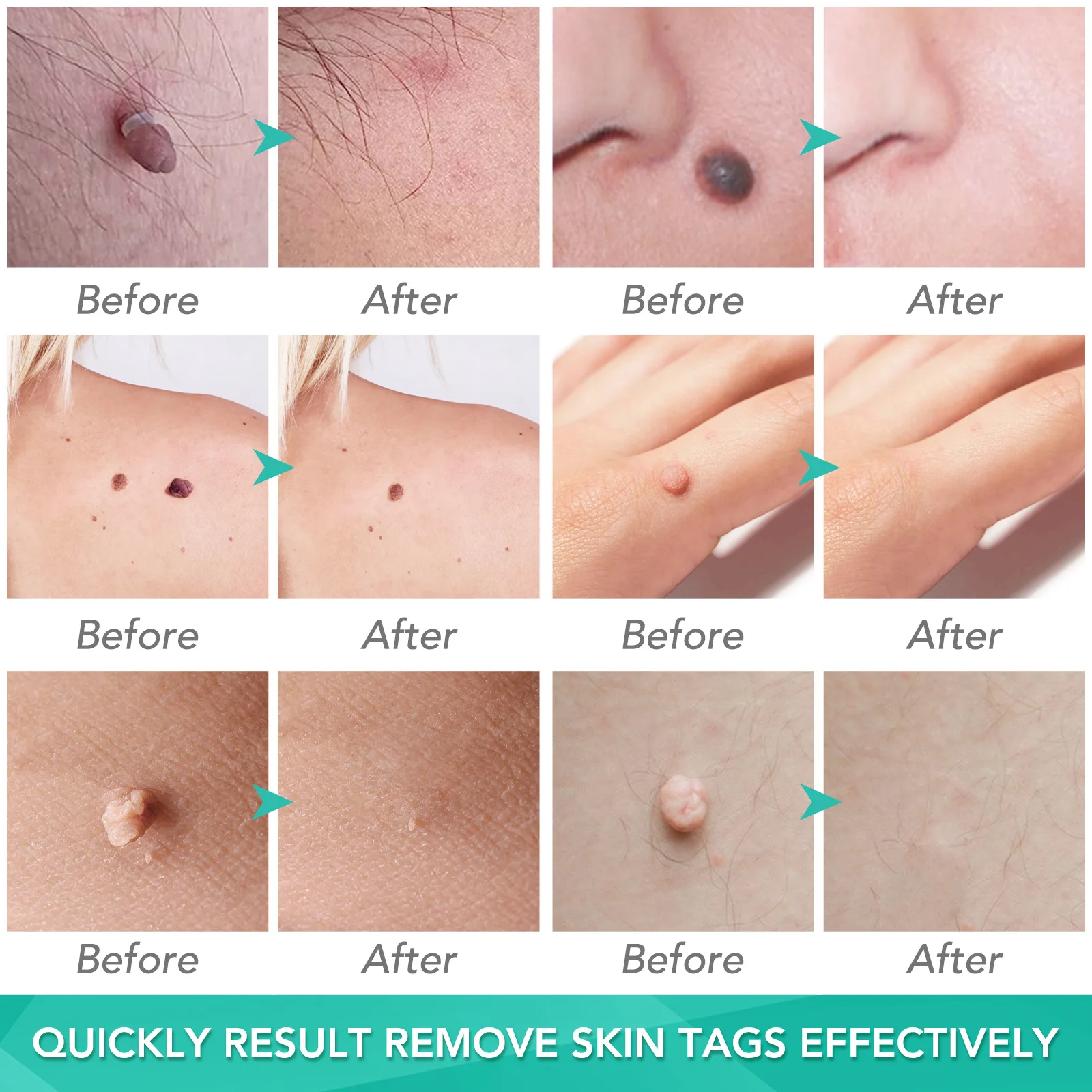 Skin Tag Removal Care Products Simple Wart Removal Tool Set Skin Tag Removeal Tool Easy To Clean Skin Care Tool