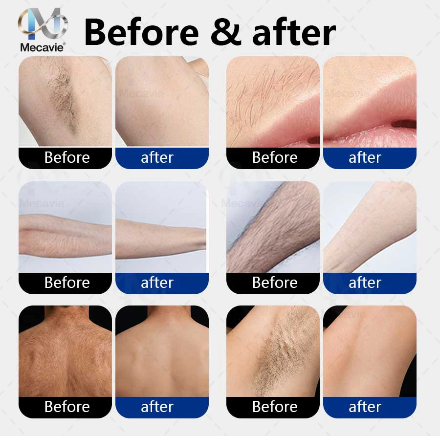 2026 Professional 5000W Four-Wave Diode Laser Hair Removal Device Suitable for Beauty Salons