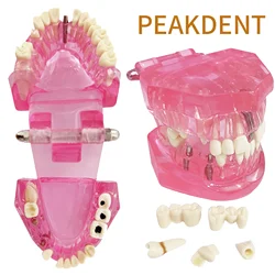 1Pcs Normal Dental Model Teeth Dental Teaching Model Transparent Pink Dentistry Adult Teeth Model And Dental Model
