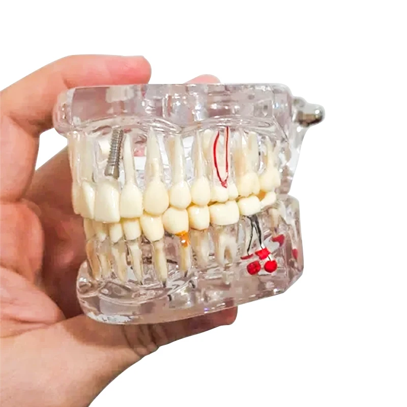 Transparent Dental Teeth Repair Model Disease Teeth Model for Dentist Student Practice Training Studying Oral Medical Tools
