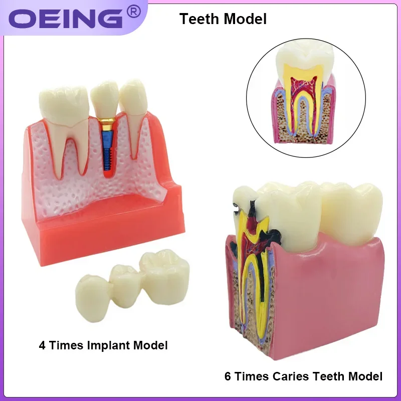 1Pc Dental 4 Times Implant Teeth Model 6 Times Caries Comparation Study Models Removable Crown Bridge Dental Teaching Model