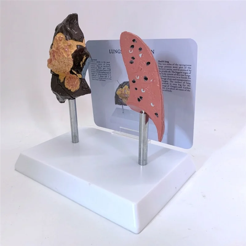 

Smoker's Lung Model Healthy Lung Model Lung Anatomy Model With Pathological Respiratory System Disease Lungs