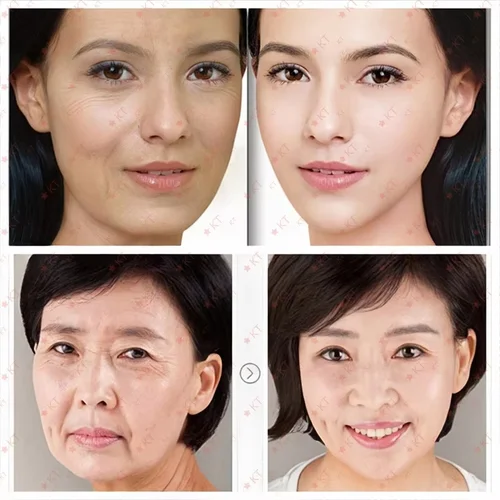 Imagen 2 del producto Hoygi Salmon DNA PDRN Rosa un día suero hidratante Facial aceite de agua equilibrado poros finos piel suave firme cosméticos Coreanos