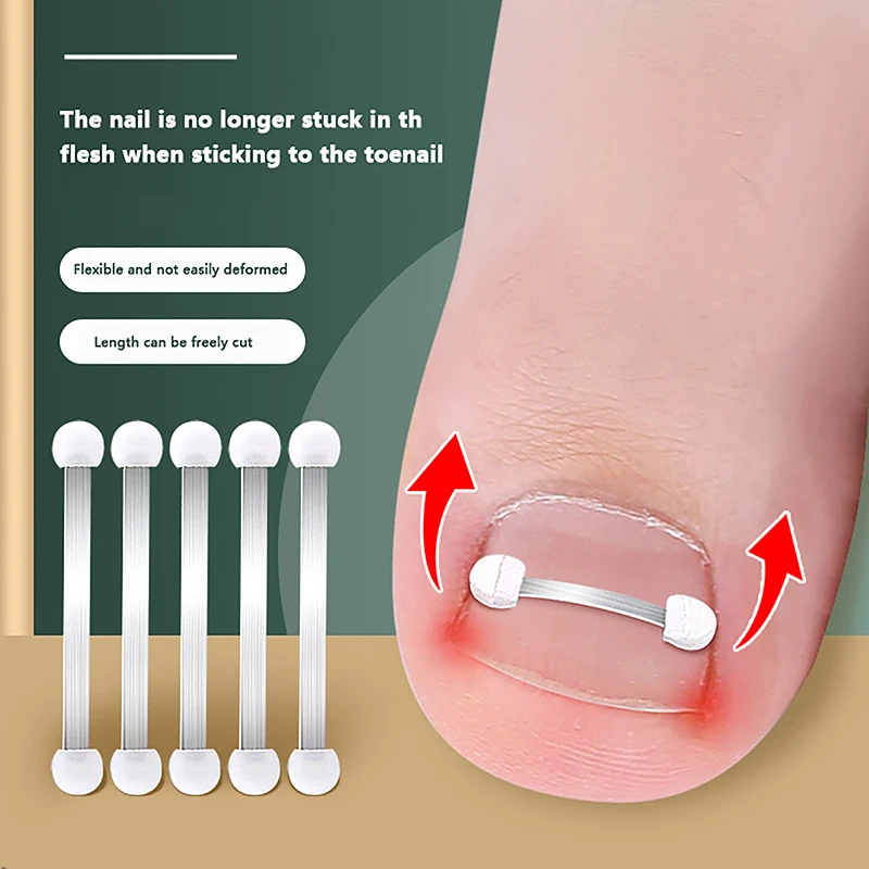 1PC Front Nail Hook Band Nail Ingrown Toe Nail Correction Toenail Nail Ingrown Clip Orthosis Paronychia Tools