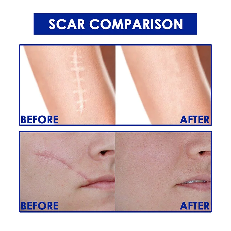 การบําบัดด้วยเลเซอร์ Keloid Scar Skin Care