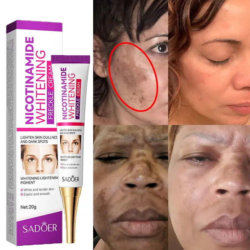 Nicotinamida crema blanqueadora para pecas, aclara eficazmente manchas oscuras, marcas de acné, elimina el Melasma, ilumina la cara, cuidado de la