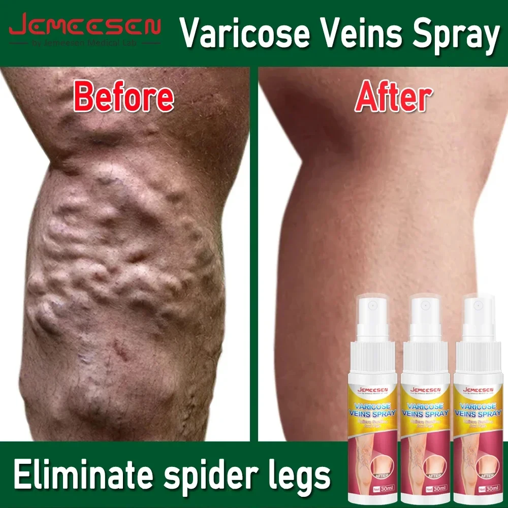 

Jemeesen Varicose Vein Spray Relieve Legs Dilated Vasculitis Phlebitis Natural Formula Liquid For Varicose Veins Body Care 30ML