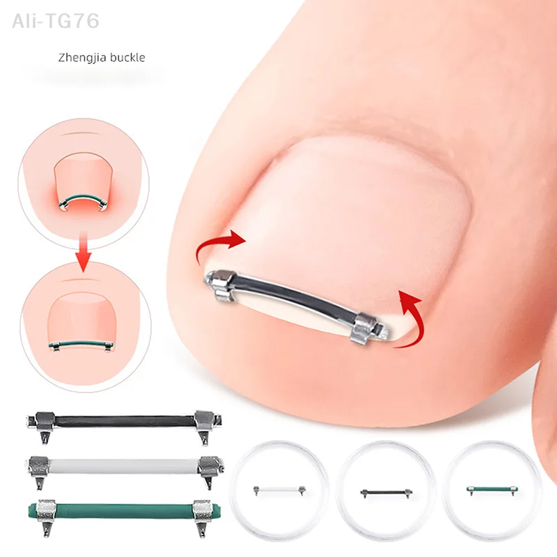 Pediküre-Werkzeug für eingewachsene Zehennägel – gebogene Klemme, Zehennagelpflege, Glättungs-Korrekturclip für Zehen – eingebettetes Nagelpflege-Werkzeug