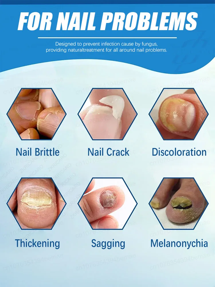 Prevent onychomycosis from getting worse and ᵖʳᵒᵗᵉᶜᵗ ᵗʰᵉ ʰᵉᵃˡᵗʰʸ ᵉⁿᵛⁱʳᵒⁿᵐᵉⁿᵗ ᵒᶠ ᵗʰᵉ ᶠᵉᵉᵗ