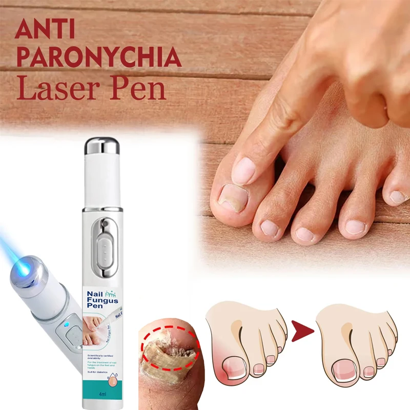 爪真菌レーザー治療装置ミニ無痛抗爪真菌症感染症灰色の爪の肥厚黄色埋め込み美白修復