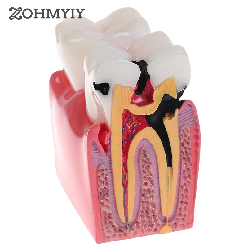 

1PC Teeth Model Dental Materials Lab Teeth Model 6 Times Caries Comparation Study Models For Dentist Studying and Researching