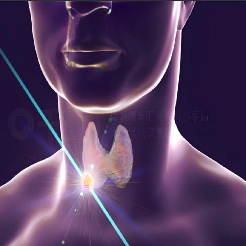 

Laser therapy for thyroid nodules