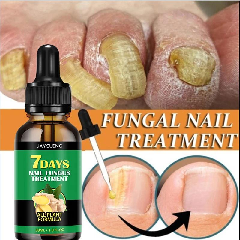 Jaysung Ginger Nail Care Serum Products Foot Nail Fungus Treatment Onychomycosis Repair Nail Fungus Feet Nails Fingernails 30ml