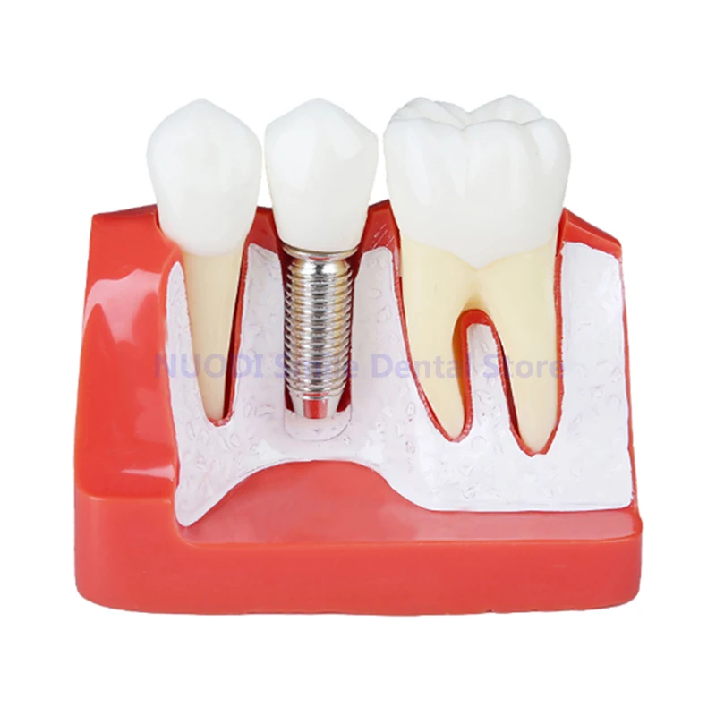 4 Times Dental Implant Teeth Model Analysis  Analysis Crown Bridge Removable Model Dentist Student Practice Studying Tooth Model