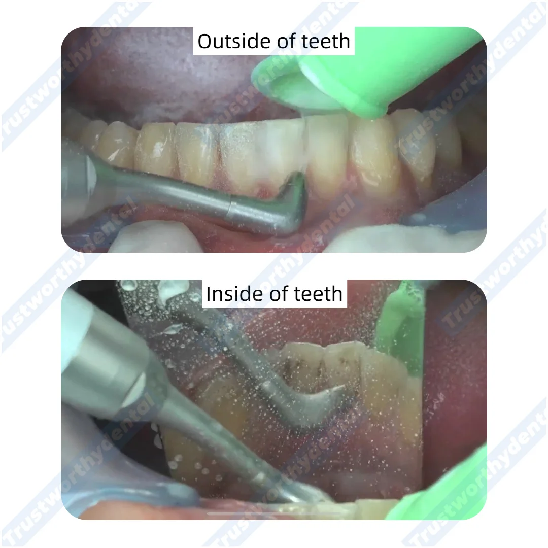 فوهة بديلة NSK Prophy Mate Neo للأسنان، طرف ملمع الهواء لنظام NEO NSK Prophy Mate 90 °    120 °   مجموعة الزوايا المتوافقة