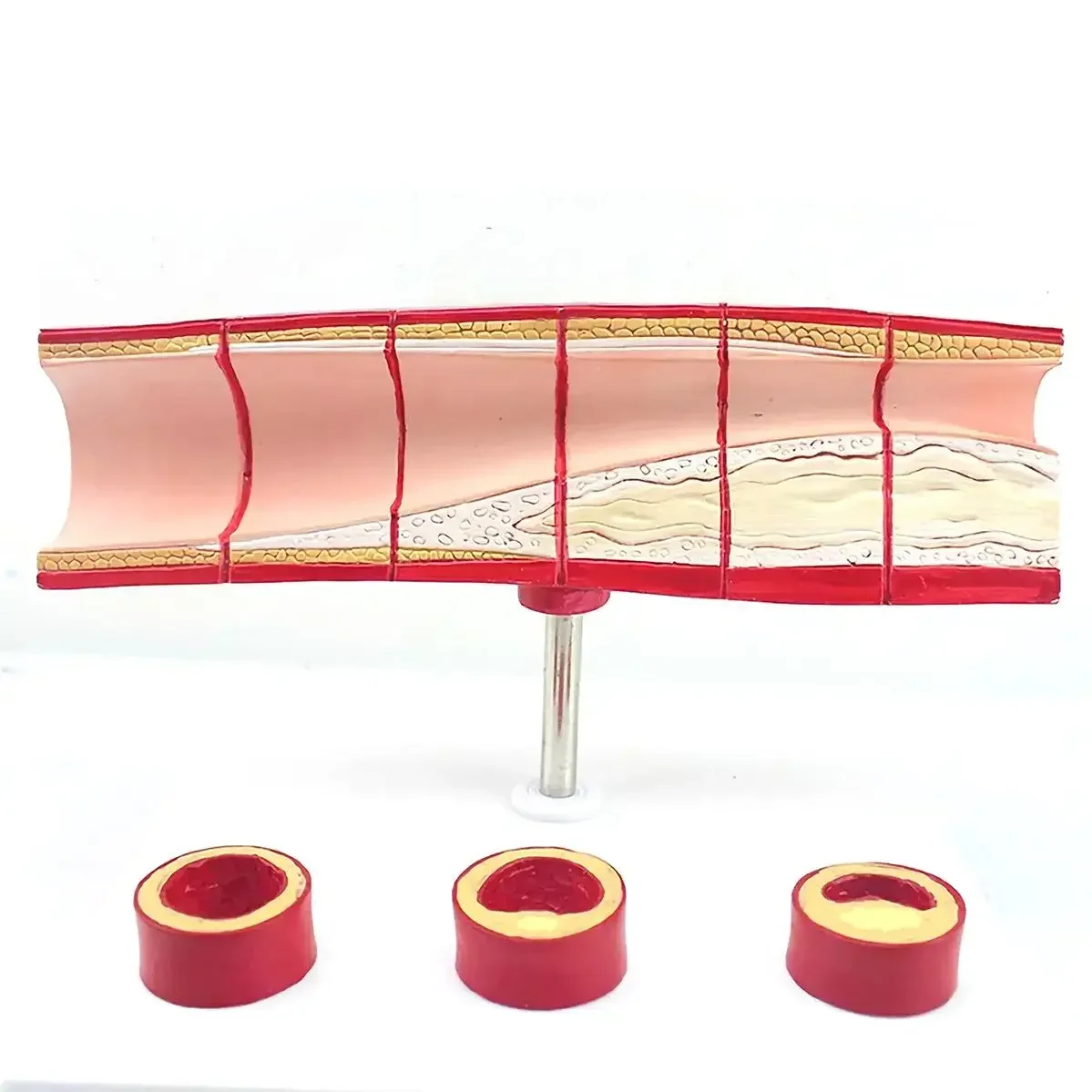 4 Parts Human Vascular Disease Of Different Ages Model Medical Teaching Models