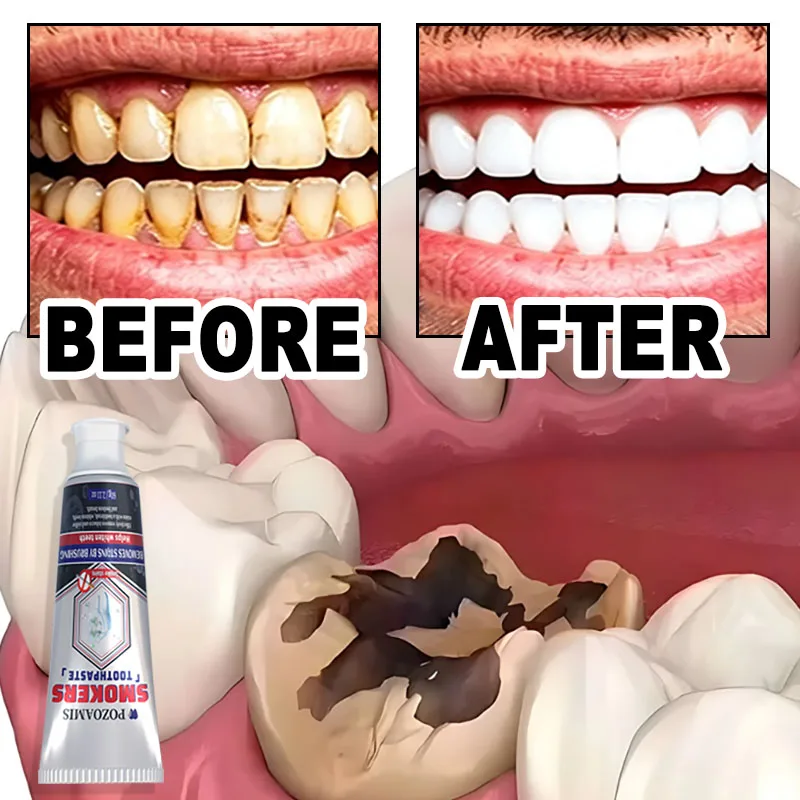 POZOAMIS Anti-cavity And Whitening Toothpaste, Cavity Repair Cream, Prevents Cavities, Protects Teeth, Deeply Cleans Between Teeth, Whitens And Freshens Breath.