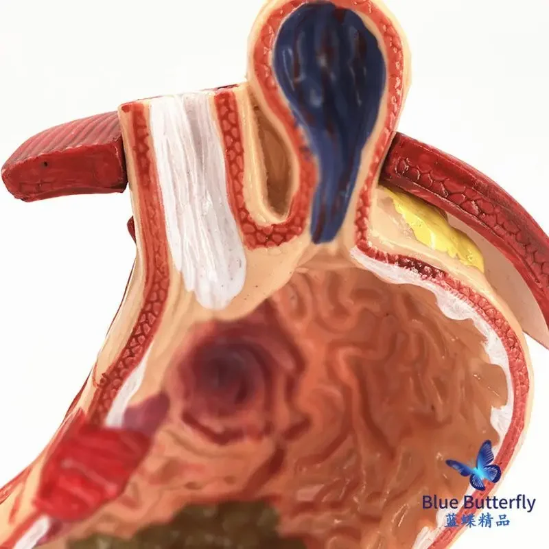 نموذج المعدة المرضية نموذج المعدة المرضية علم الجهاز الهضمي القسم التاوي التوسع التشريحي