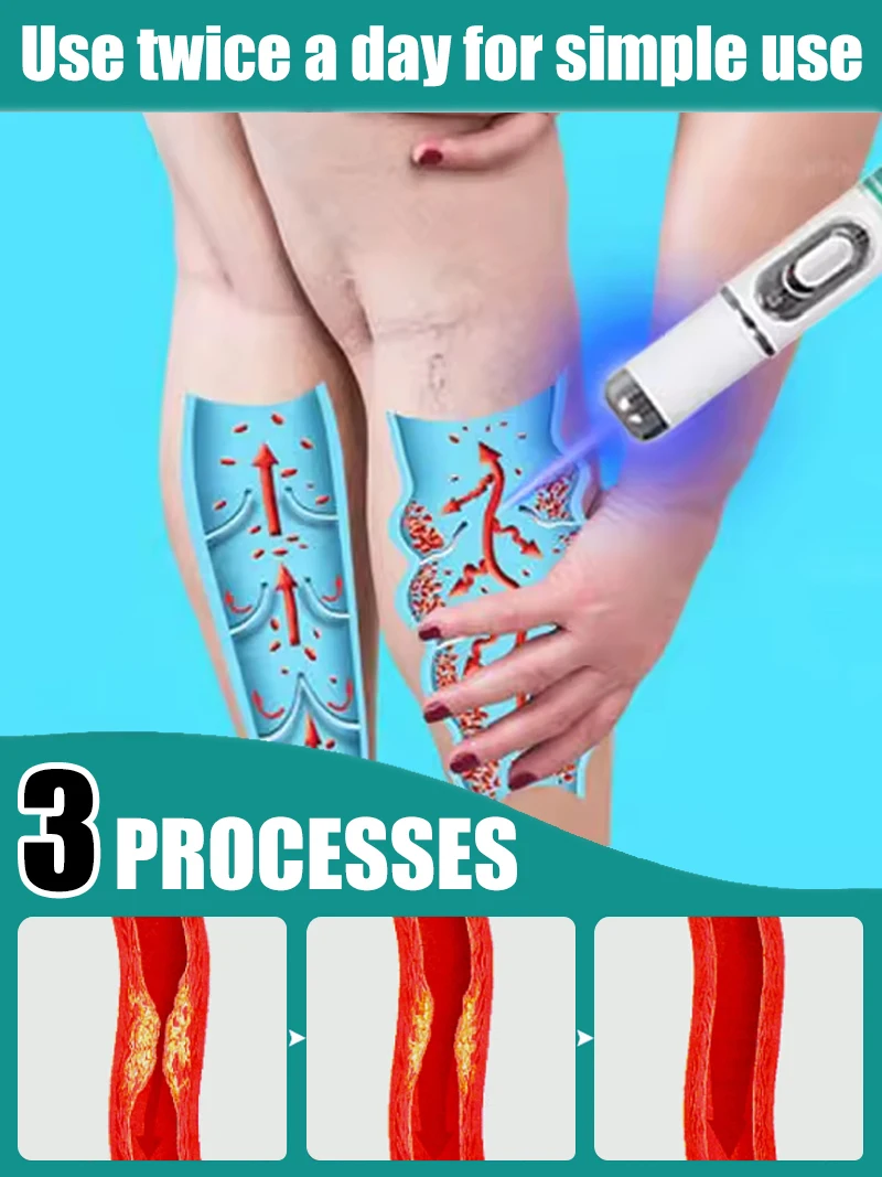 blue light pen solve varicose veins,2025 NEW hot sale leg care tools