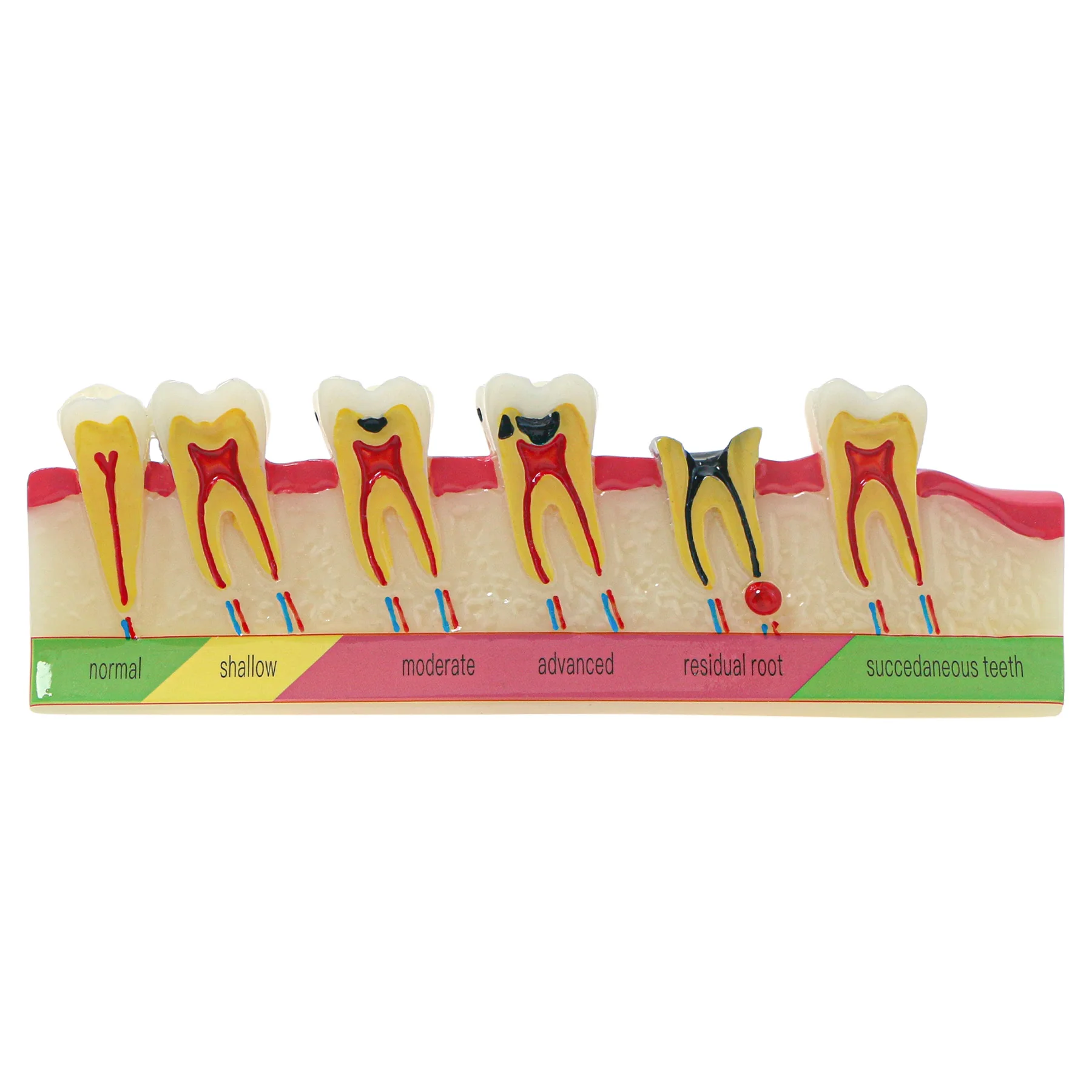 

Dental Caries Disease Model Pathological Typodont Teeth Disease Demo M4028