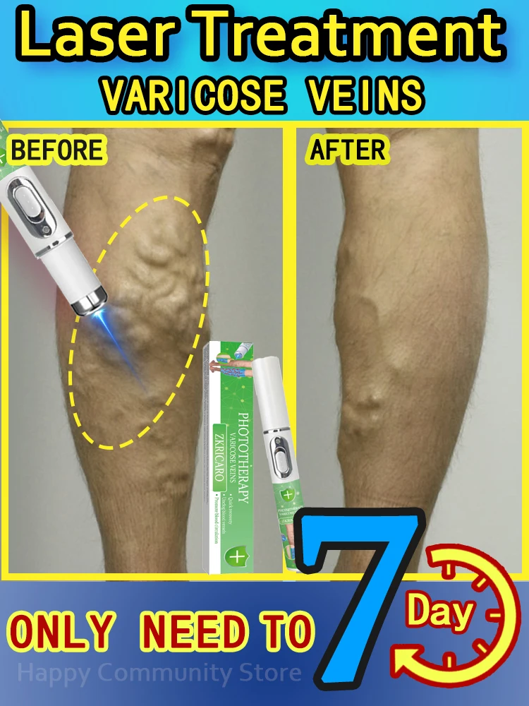 

Hot sale Nano Laser Leg Vein