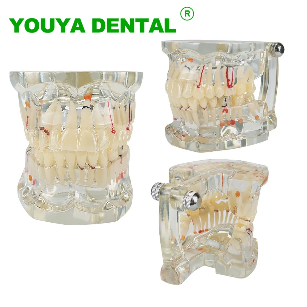 Dental Teaching Model Pathological Model Disease Caries Teeth Model For Dentist Student Study Training Practice Dentistry Tools