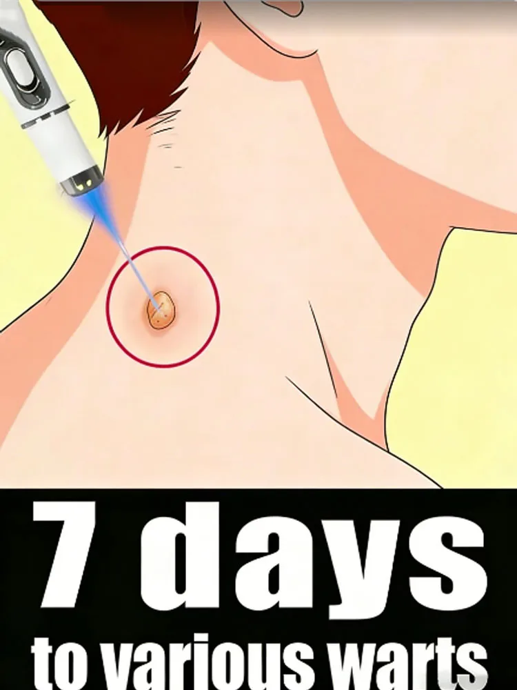 

Новейшая ручка с синим светом, при длительном использовании, вызывает сухость и отслаивание бородавок.