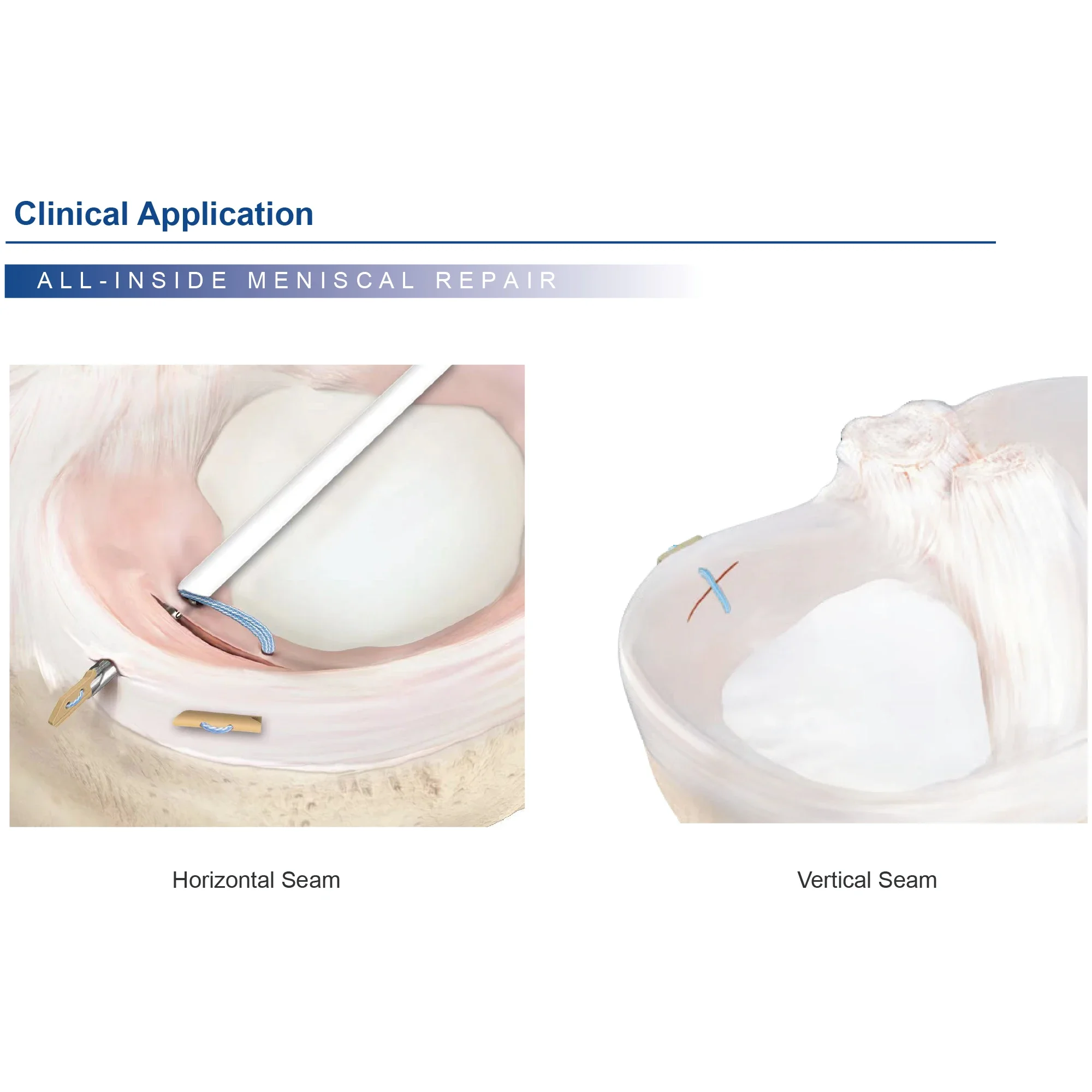 Orthopedic Meniscal Repair Needle for Fast Fix