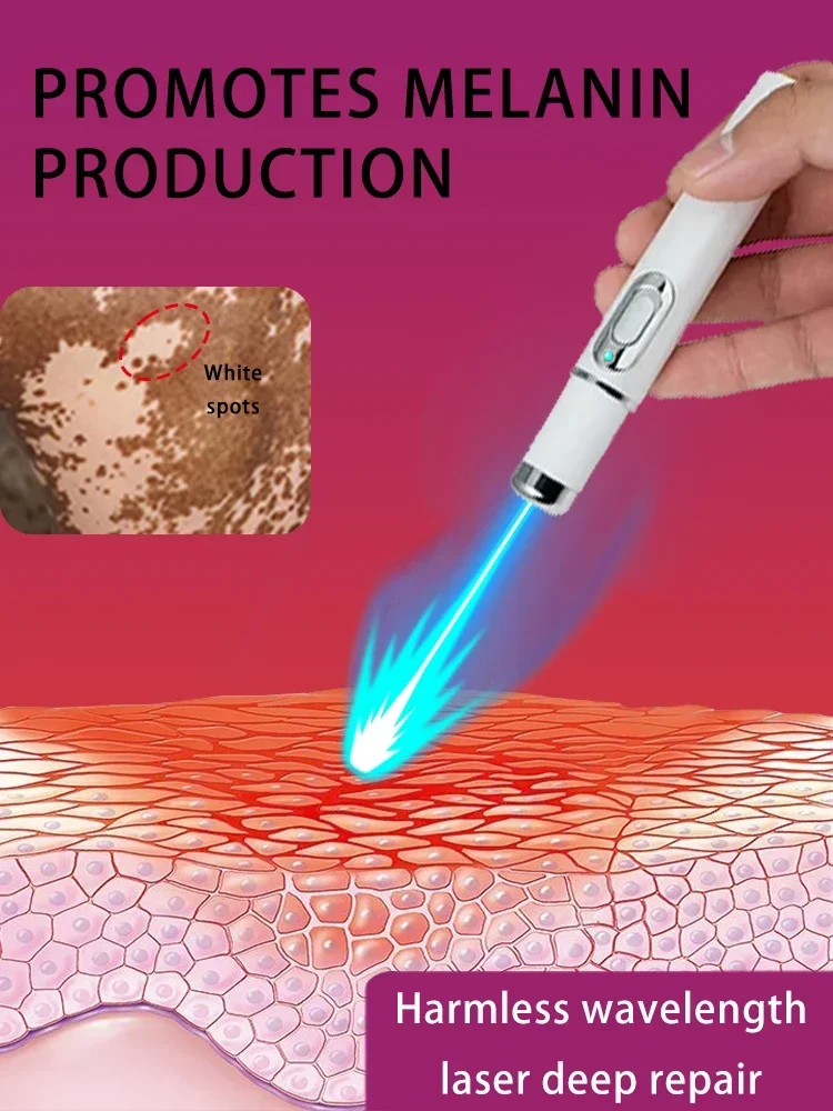 Vitiligo- White Spots Blue Light Lase Technology