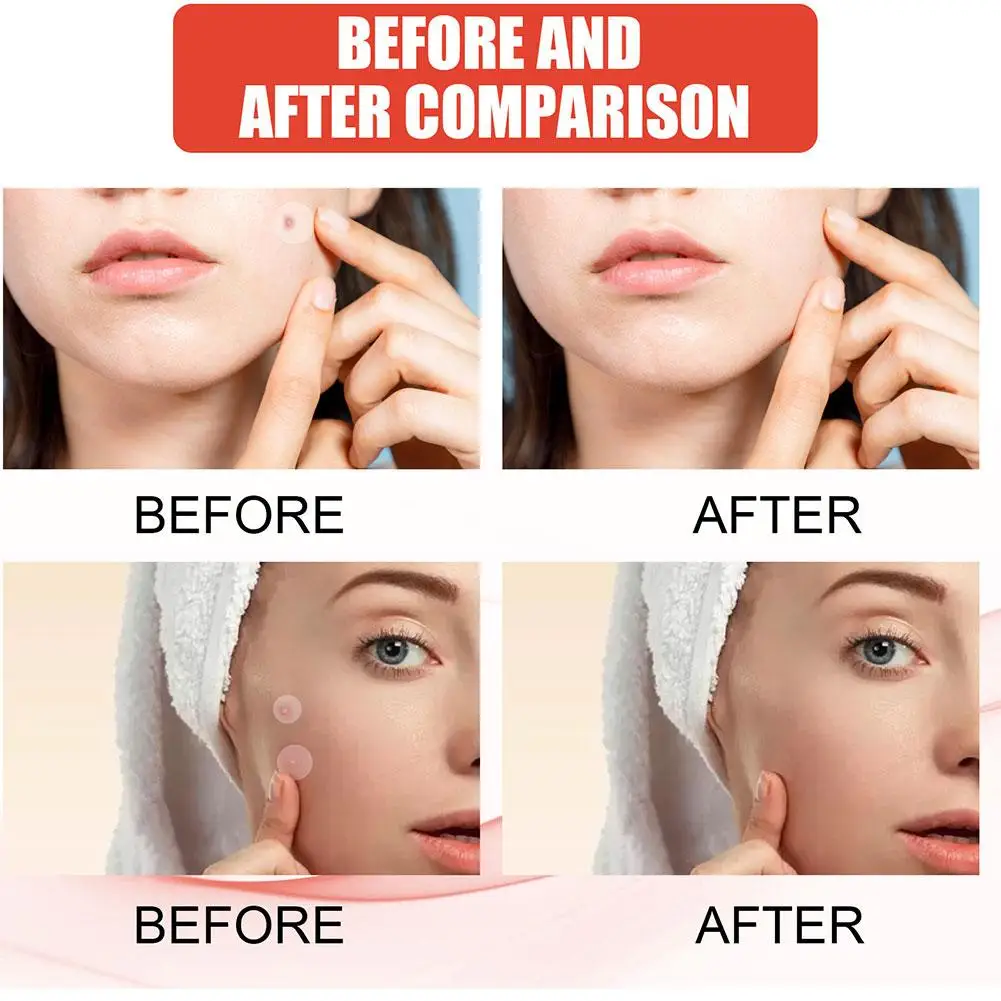 360 قطعة غرواني مائي غير مرئية بثرة التصحيح حب الشباب ملصقات الوجه المخفي للبقع حب الشباب البثور الجمال ماكياج أداة غطاء لطيف