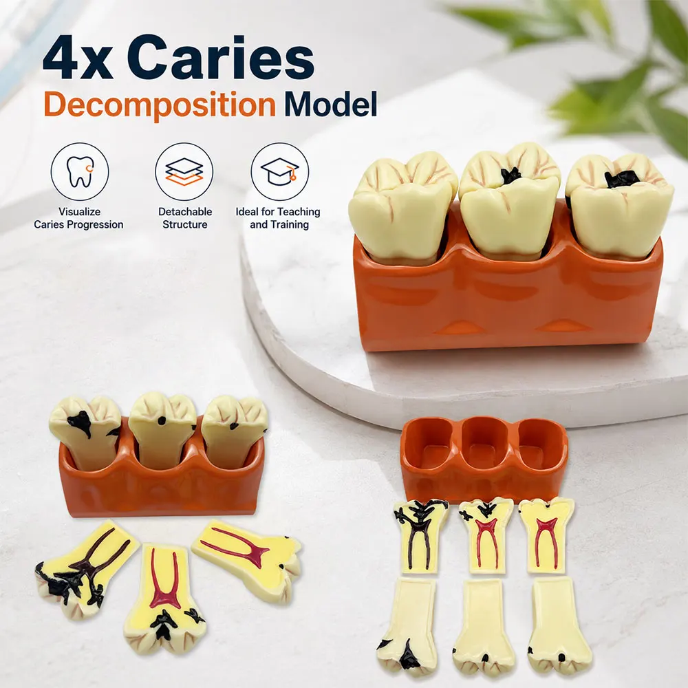 Multi‑Type Resin Dental Implant Restoration Model Periodontal Caries Root Canal Anatomy Teeth Model Dentistry Training Teaching