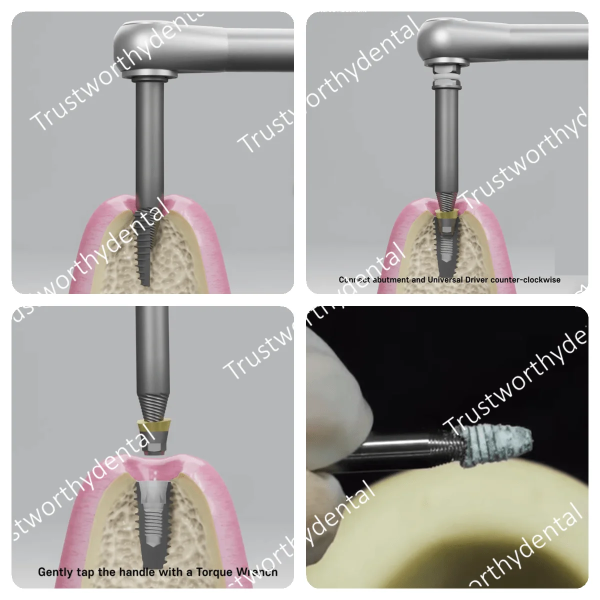 Dental Implant Removal Kit Bone Expander SOS Set Remove Broken Fixture Ratchet Wrench