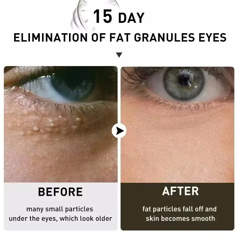 Fat Granules Remover Eye Cream Anti-Puffiness Anti Inflammatory Reduce Dark Circles Eyebags Fade Lines Moisturizing Eye Care view 5