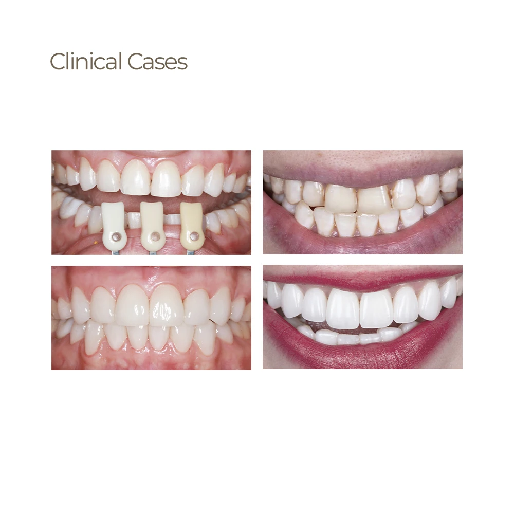 LODDEN C14 Lithium-Disilikat-Glaskeramikblöcke ohne Sintern Sirona CAD/CAM Dentallabor Kronenrestaurationsmaterialien – Detail 7