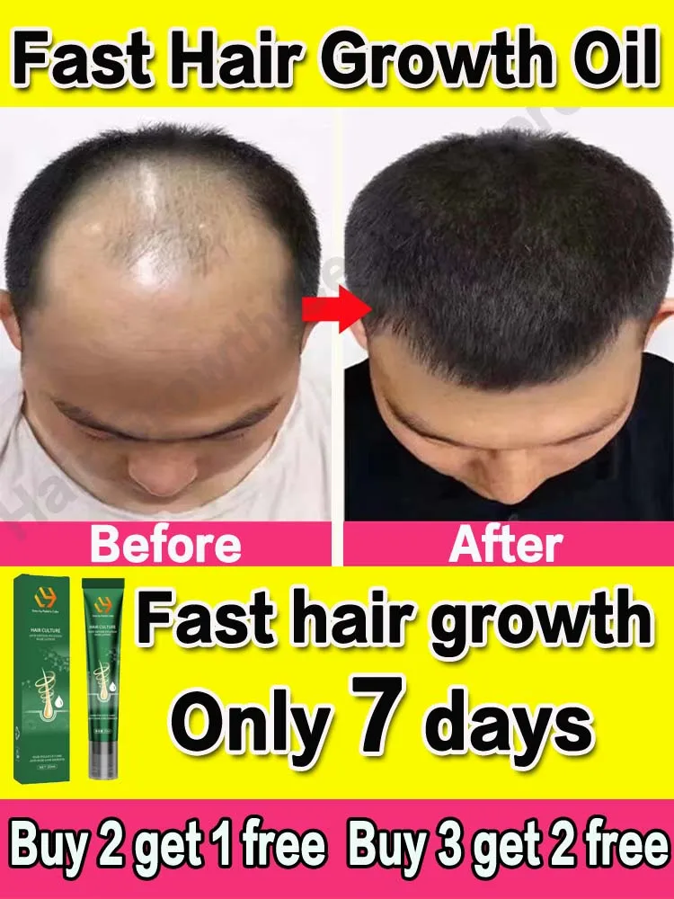 Hair Growth Oil Fast Hair Growth Effective Baldness Repair Hereditary Hair Loss Postpartum Hair Loss Seborrheic Hair Loss