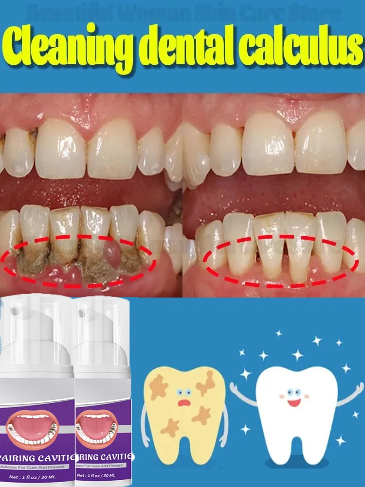 

Teeth cleaning ，whitening Teeth stains alculus Plaque Periodontitis， freshen bad breath，and remove Cavities