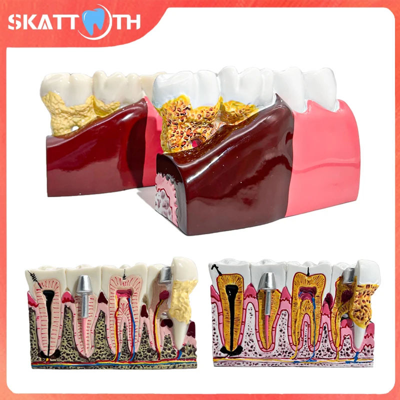 1Pcs Dental Model Caries Anatomy Model Comprehensive Pathology Tooth Nerve Tooth Model Dental Oral Teaching Demo Teeth Model