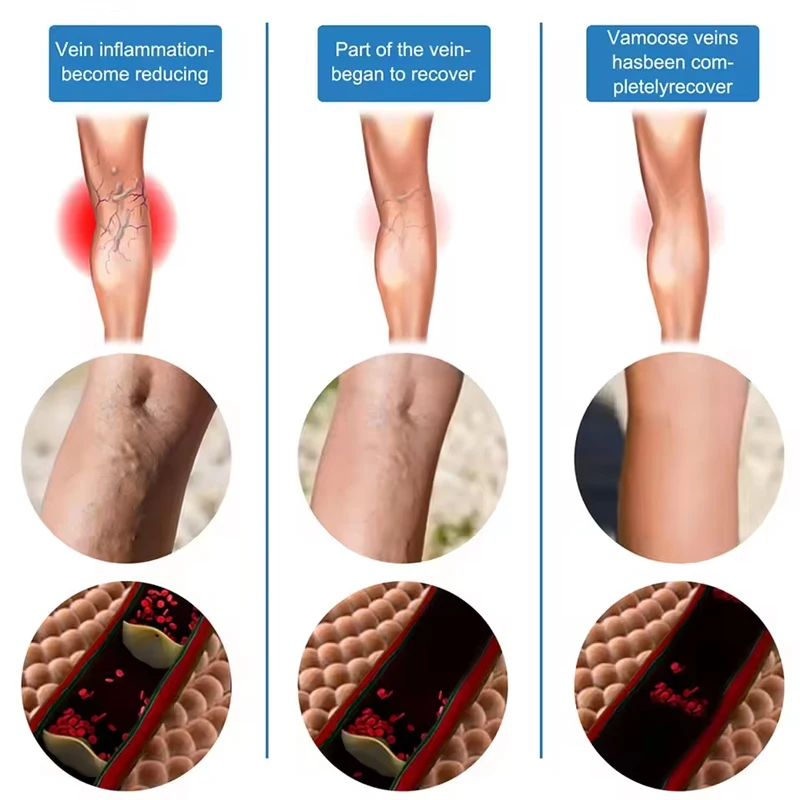 Generacja Laserowa Trzecia na Żylaki - Laserowy Punktator do Leczenia Eliminuje Zapalenie Naczyń i Żylaków, Łagodzi Ból Pajączkowych Nóg