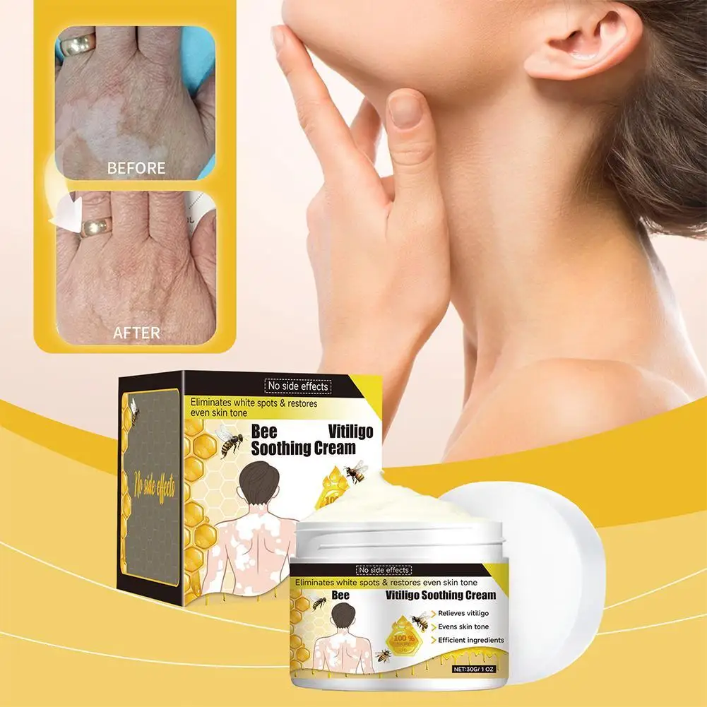 30gBee Vitiligo Treatment Cream Natural Relief Skin Treatment Soothing White Spot Removal Vitiligo Serum Eliminate Pigment