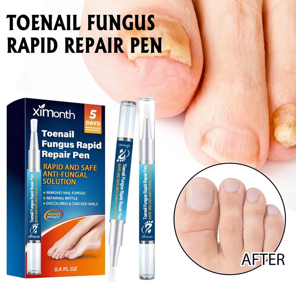 12Ml Nageltherapie Pen Onychomycosis Paronychia Anti Schimmel Nagelolie Nagels Verzorging Behandeling Vinger Teen Nagelverzorging 4Pc Reparatie Tools