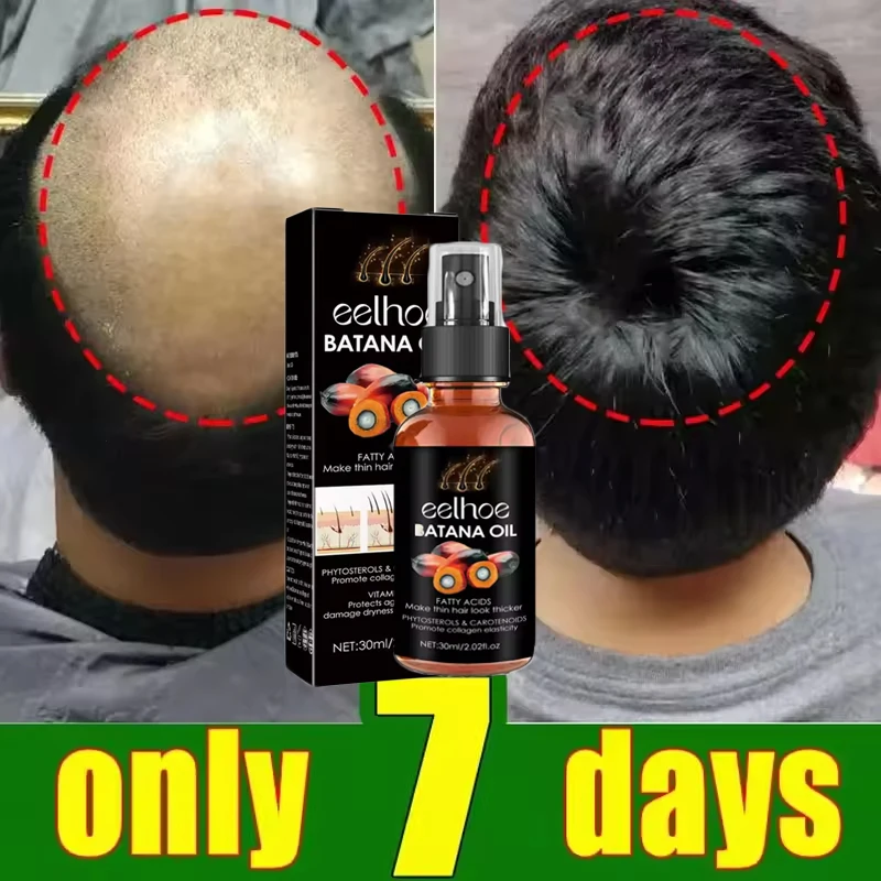 100% زيت باتانا النقي رذاذ نمو الشعر للرجال والنساء مكافحة فقدان الشعر إعادة نمو زيت طبيعي علاج فروة الرأس منتجات العناية بالشعر #3