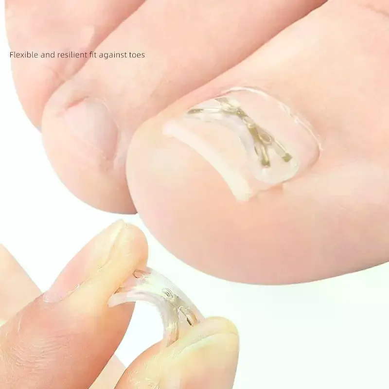 13/15/17MM Nail Correction Stickers Ingrown Toenail Corrector Patches Paronychia Treatment Recover Corrector Pedicure Tools