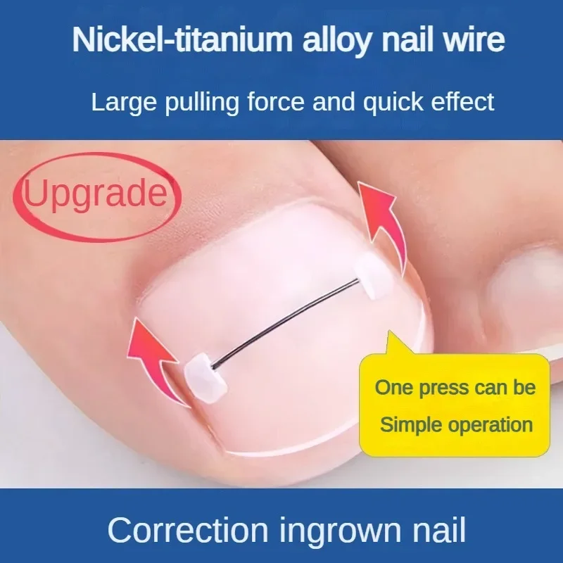 Ingrown Toenail Corrector Tools Pedicure Recover Embed Toe Nail Treatment Professional Ingrown Toenail Straightening Clip Brace