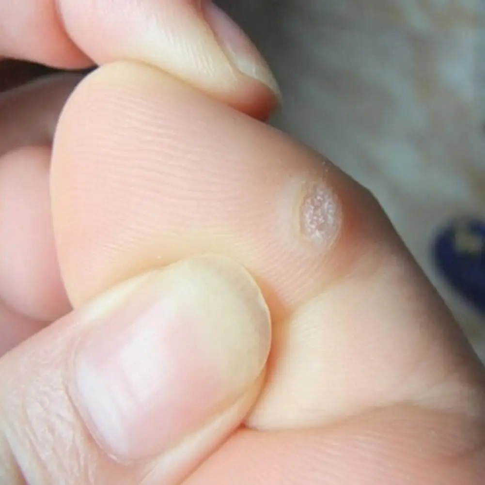 Zehen- und Fußschutzpolster, Hühneraugen, Hornhautfüße, wunde Schuhe, Aufkleber, selbstklebende Kissen, weiches Fersenpolster, Schaumstoff-Fußpaste, 30 Stück