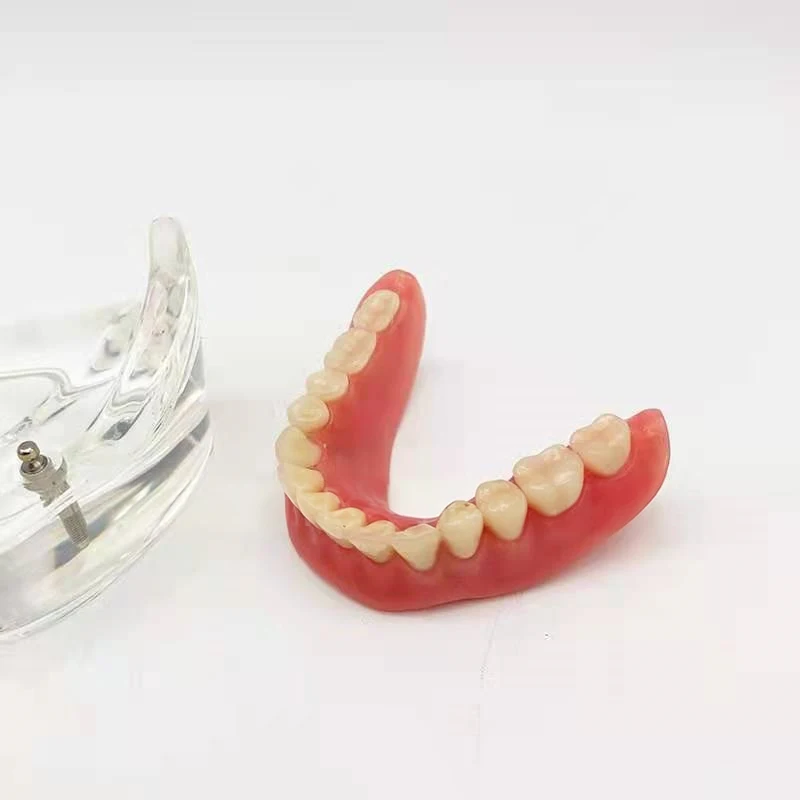 Life Size Human Teeth Dental Implant Display Teeth Oral Anatomical Model Dental Restoration Teaching Model