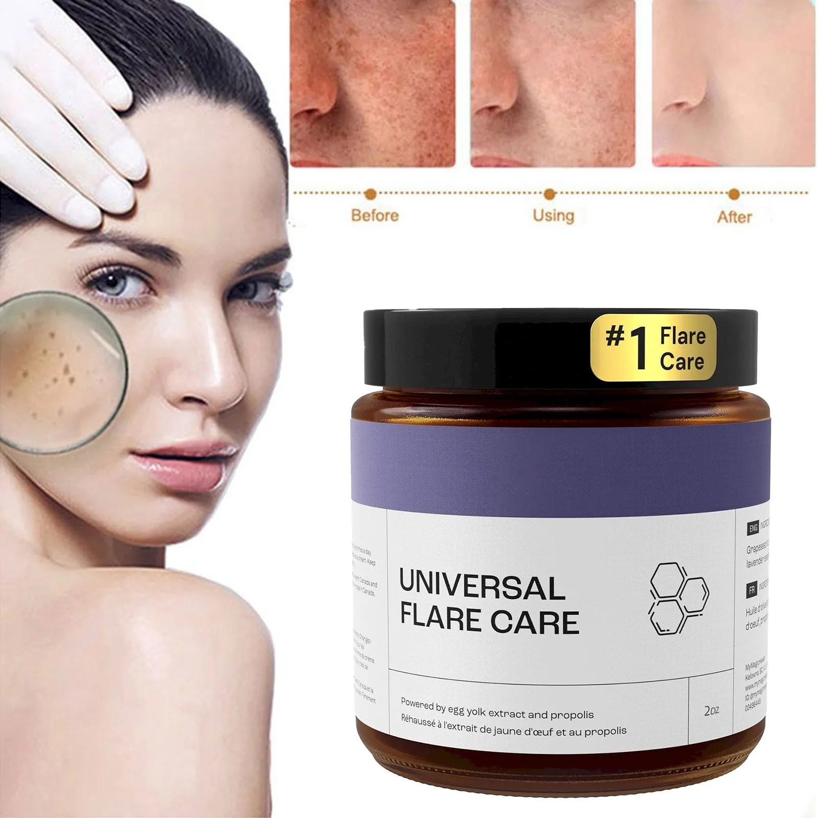 Acne Care U Niversal R Elieve Skin Problems Hidradenitis Suppurativa Abscesses Solution With And Egg Yolk Extracts 1.8 Oz